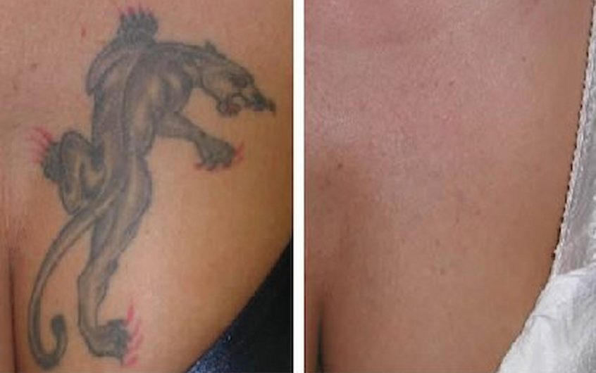 Visit The Right Clinic For Tattoo Removal Services